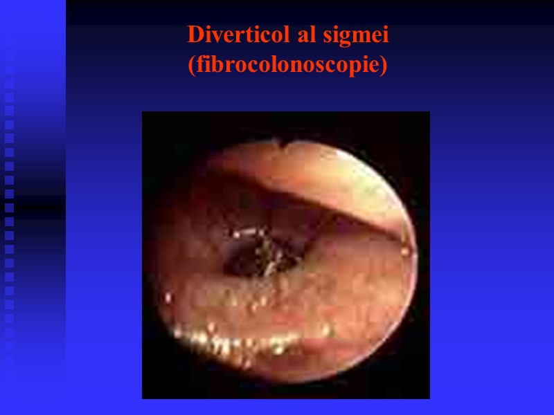 Diverticol al sigmei  (fibrocolonoscopie)